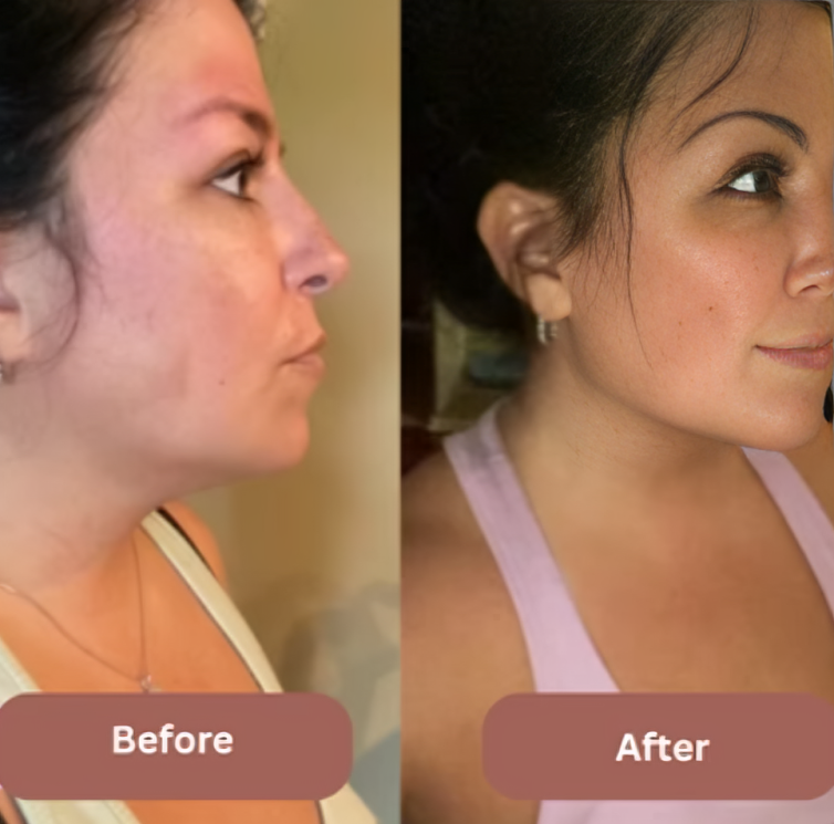 Face Slimming Strap™