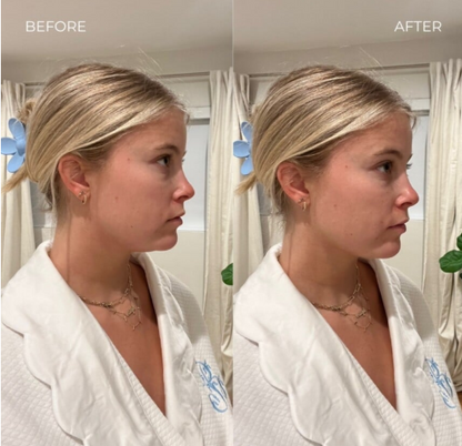 Face Slimming Strap™