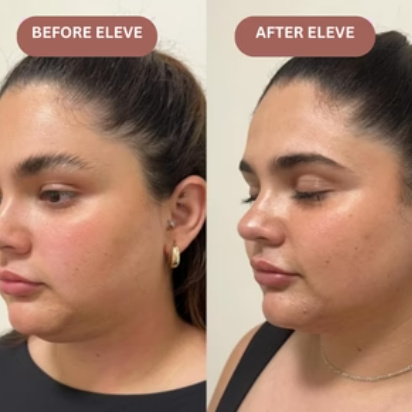 Face Slimming Strap™