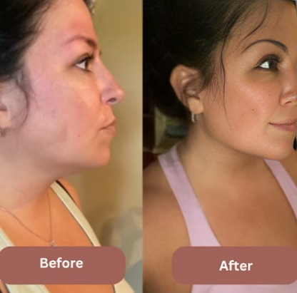 Face Slimming Strap™