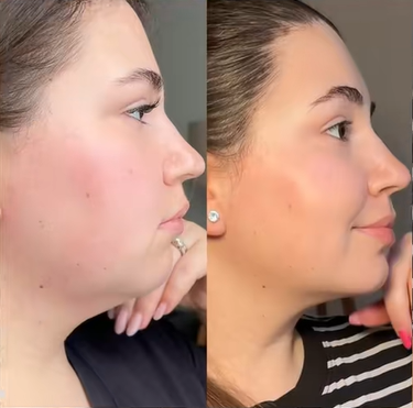 Face Slimming Strap™