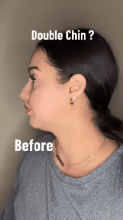 Face Slimming Strap™